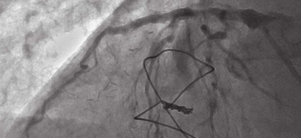 Kardiologia Inwazyjna nr 5 (10), ROK 2015 Przekrój poprzeczny w miejscu minimalnego pola stentu (MSA = 4,52 mm 2 ).