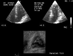 B. Firek, Zastosowanie echokardiografii trójwymiarowej A B Ryc. 6. Badanie obciążeniowe (dobutamina) z wykorzystaniem systemu RTVR-3DE. A. W badaniu spoczynkowym widoczna prawidłowa kurczliwość mięśnia lewej komory.