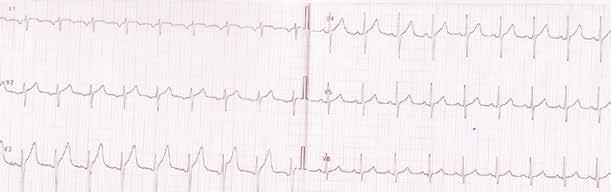 rzadko. Rozpoznanie W badaniu elektrokardiograficznym (EKG) stwierdza się częstoskurcz z wąskimi zespołami QRS.