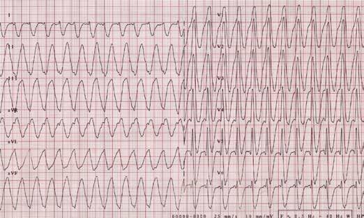 Repetytorium z kardiologii Rycina 2. Diagnostyka różnicowa częstoskurczów z szerokimi zespołami QRS kryteria morfologiczne.