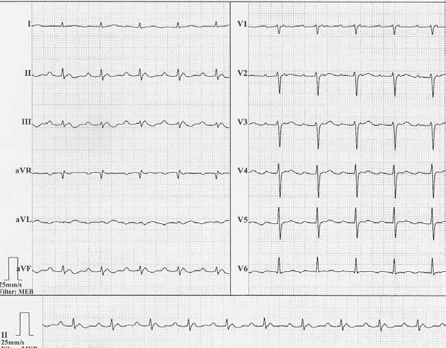 atrioventricular nodal reentrant tachycardia) oraz trzepotanie przedsionków (AFl, atrial flutter).