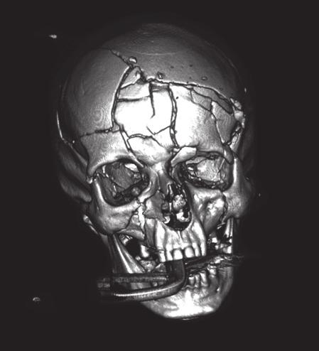 Witt and Leśniak/JNNN 2016;5(1):28 30 aesthetics with opioids such as Fentanyl than in the combination of anaesthetics with muscle relaxant drugs.