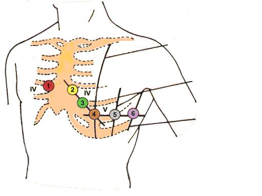 4.4. Zapis nowego badania EKG 4.4.1. Rozmieszczenie elektrod Elektrokardiograf wyposażony jest w 10 elektrodowy kabel pacjenta.