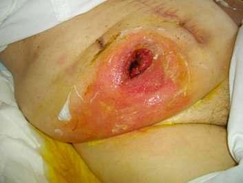 Faktem jest, że można mieć udane życie seksualne ze stomią, tak jak można nieudane życie seksualne bez stomii.