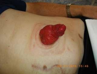 rozdęcie jelita w trakcie zabiegu) i pooperacyjnymi (zakażenie tkanek wokół stomii, niedrożność pooperacyjna, radioterapia, wzrost wagi ciała, długi czas życia ze stomią).