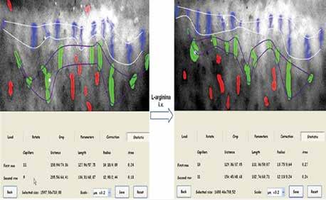Choroby Serca i Naczyń 2014, tom 11, nr 3 Rycina 11. Wynik analizy obrazów kapilaroskopowych za pomocą programu (przed i po infuzji L-argininy) 3. http://www.history-of-the-microscope.