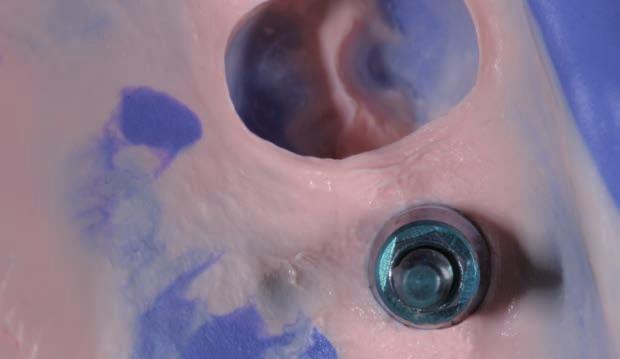 Niezawodność Najlepszy sojusznik w Twojej pracy Hydrorise Implant docenia Twój czas. Niezbędne narzędzie w codziennej pracy dentystów, którzy chcą zwiększyć efektywność pracy i zadowolenie pacjentów.