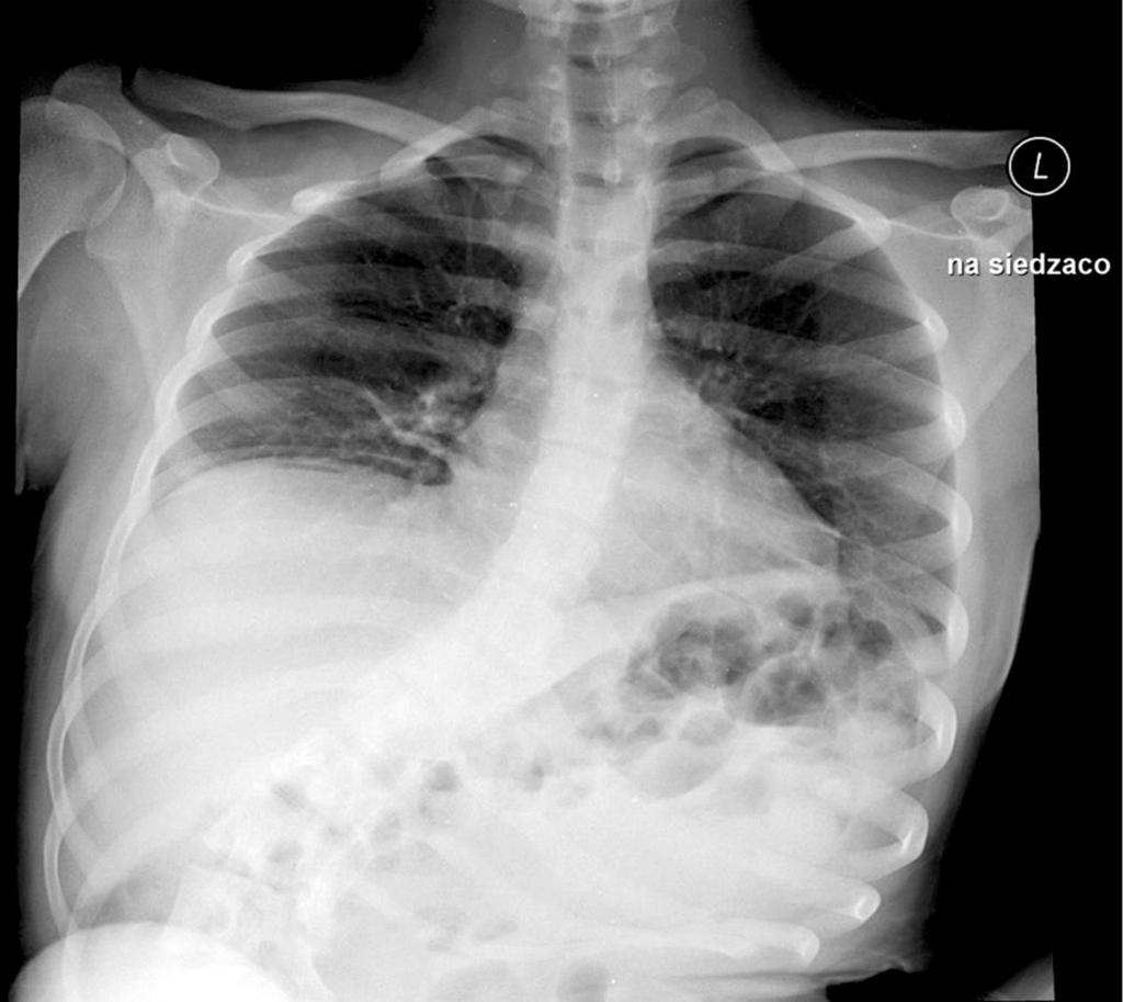 Rycina 2. Przeglądowe zdjęcie klatki piersiowej i jamy brzusznej Rycina 3. Stan po implantacji cewnika Tenckhoffa bości do 5 mm; w najwęższym miejscu światło przepływu w żyle pachowej do 5 mm.