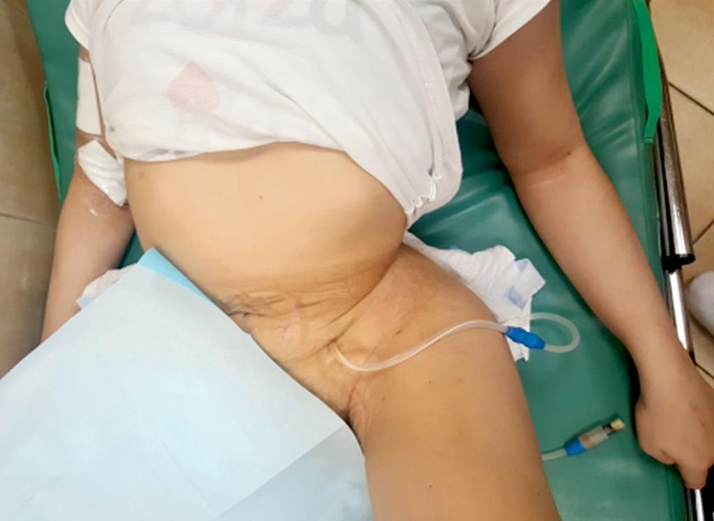 Po lewej stronie kręty przebieg żyły udowej i światło naczynia 3 mm nie dawały możliwości kaniulacji.