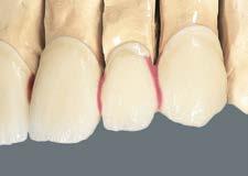 W przypadku mostów, należy przed rozpoczęciem napalania ceramiki wyseparować przęsła aż do granicy podbudowy. Praca przygotowana do pierwszego napalenia dentyny.