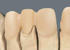 11 VITA MODELLING FLUID RS Do mieszania wszystkich mas dentyny, szkliwa i mas uzupełniających Delikatna konsystencja płynu umożliwia długie i wilgotne nakładanie mas