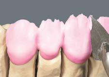 Nakładanie warstw wg schematu BUILD UP Nałożenie VITAVM 9 TRANSPA DENTINE Masą TRANSPA DENTINE