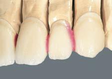 Nakładanie warstw wg schematu BUILD UP Wygląd uzupełnienia po pierwszym napaleniu dentyny.