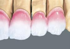 Korektę kształtu uzupełnienia rozpoczynamy masą TRANSPA DENTINE a w rejonie brzegu