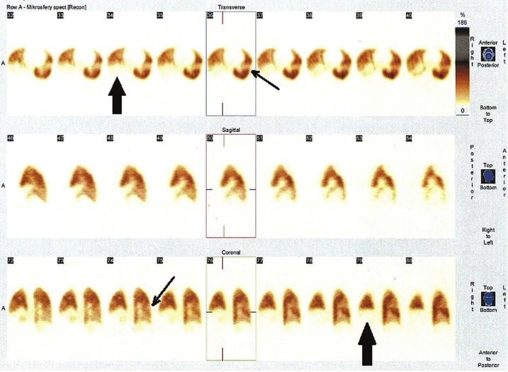 Badanie scyntygraficzne perfuzji płucnej wykonane techniką plenarną i SPECT. Liczne klinowe ubytki w obu płucach (strzałki cienkie). Nie uwidacznia się dolna część prawego płuca (strzałki grube).