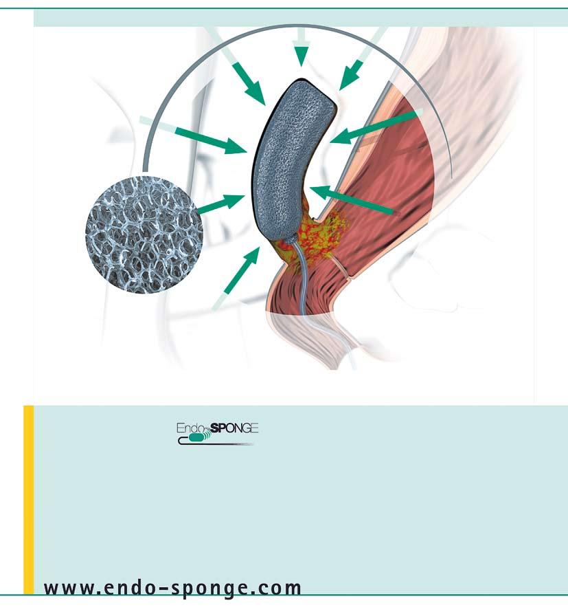 Leczenie za pomocą Przestrzeń ropnia jest drenowana poprzez wprowadzany endoskopowo system Endo-Sponge, połączony z butlą Redyrob