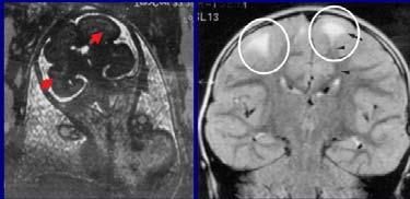 Body Clinical Features The tuberous sclerosis complex (TSC) is an autosomal dominant disorder affecting children and adults resulting from mutations in one of two genes, TSC1 (TSC1) or TSC2 (TSC2).