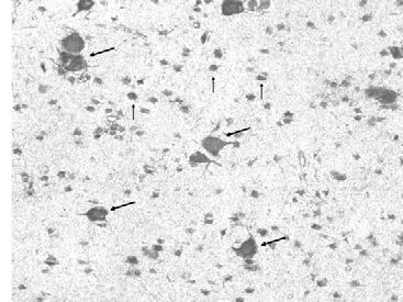 However, the most disabling manifestations of TSC reflect abnormalities in brain function.