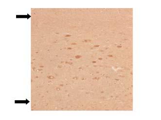 second hit mutations. A logical next question is whether somatic mutations occur at a developmental critical period and whether they occur simultaneously in a shower of mutational events.