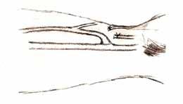 Oryginalne zespolenie zaproponowane przez K. Gracza; C. Modyfikacja zespolenia zaproponowana przez K. Konnera w tabakierce anatomicznej [3].