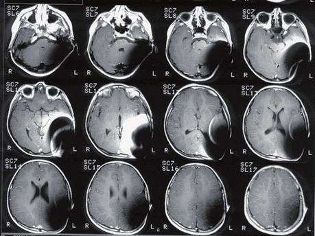 C40 Rysunek 1: Bandażowanie głowy w celu zabezpieczenia mocowania implantu