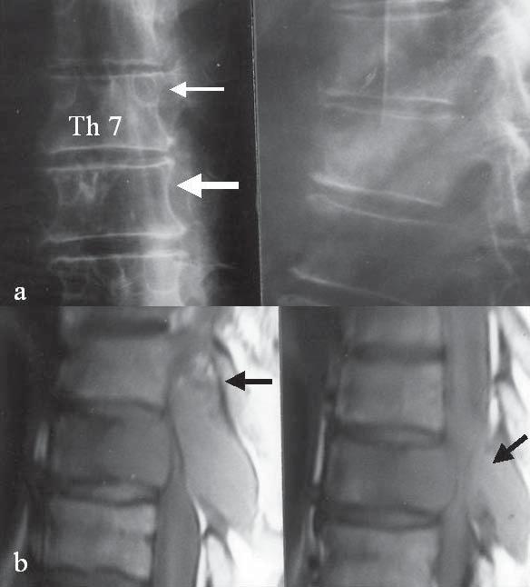 ment. In these cases, the need for immediate surgery should be considered. The infiltration of the pediculus is an equally important factor indicating that surgery is necessary.