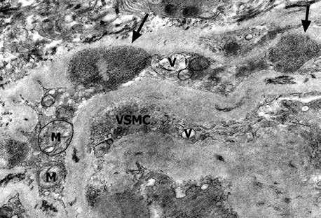 Results Ultrastructural examination of muscle and skin vessels showed GOM deposits, numerous in arterioles A but very rare in capillaries. Blood vessels in skeletal muscle were dramatically changed.