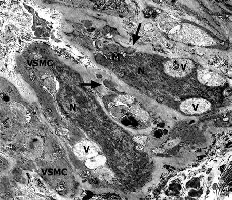 size, including vacuoles containing mitochondria, were the most characteristic finding (Figs. 4A-C). Some giant vacuoles were surrounded by a double membrane similar to the mitochondria (Fig. 4B).