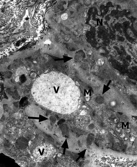 Interestingly, shrunken and irregularly shaped nuclei were present in all mural cells (Figs. 4A and 5). Light microscopic examination revealed granular deposits in the wall of vessels (Fig. 6A).