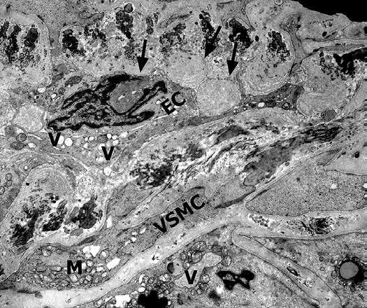 Eliza Lewandowska, Teresa Wierzba-Bobrowicz, Julia Buczek, Grażyna Gromadzka, Dorota Dziewulska Fig. 5. Arteriolar wall with hyaline material (ar rows) located near endothelial cells (EC).