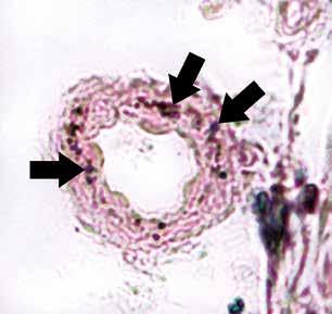 A B C D Fig. 6. Calcium deposits in arteriolar walls.