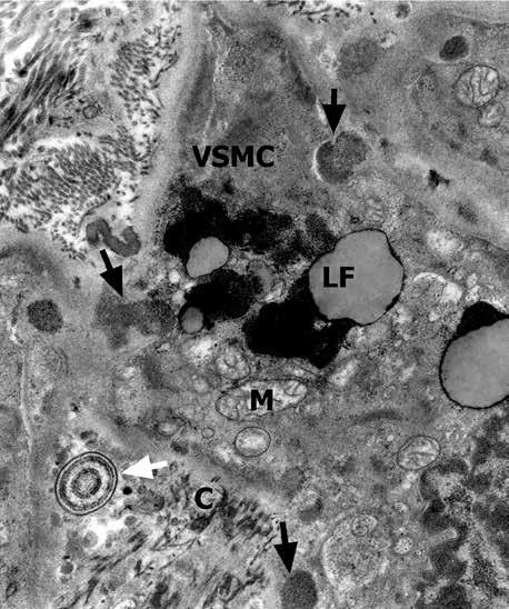 (B) single laminar calcium deposit (light arrows) in a thickened basement membrane