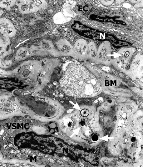 In VSMC lipofuscin (LF), swollen mitochondria (M) are visible.