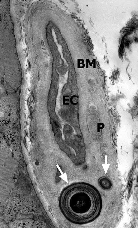 (B) Thickened basement membrane with laminar calcium deposits (arrows) and re sidual pericytes (P). Endothelial cell (EC). Orig. mag. 7000.