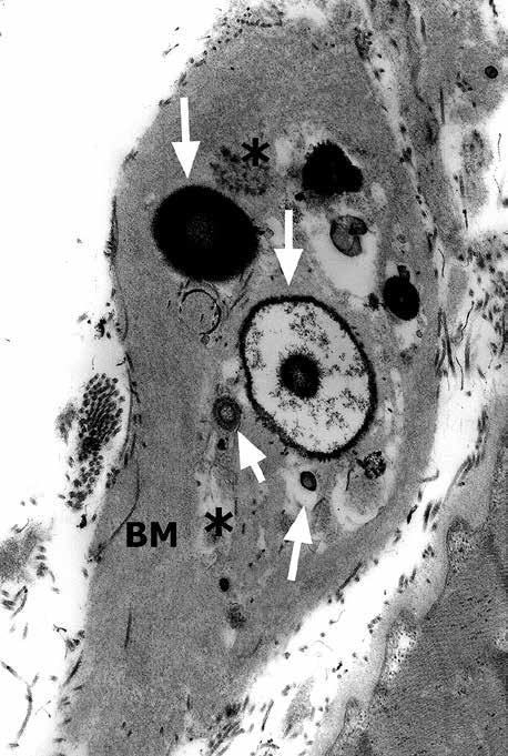 In many arterioles there was a myriad of GOM deposits in both indentations of VSMC cytoplasmic membranes or free within the thickened basement membrane as described previously [2,7,19,25].