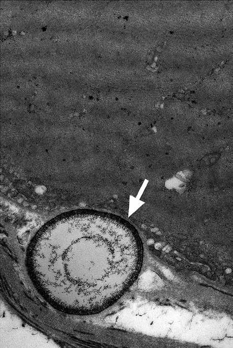 (A) Grain of calcium under sarcolemma (arrows).