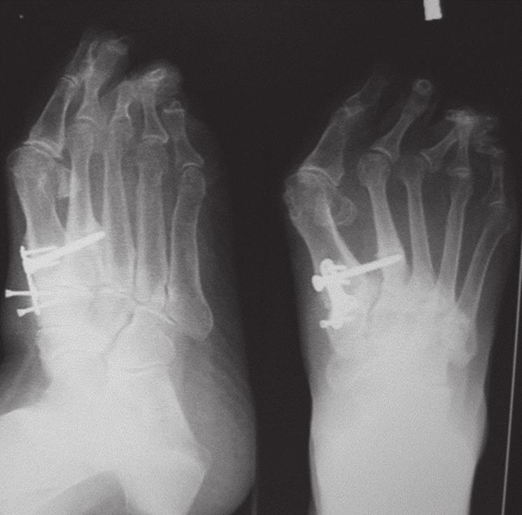 278 D C E Rycina 23.9.. Typowe zniekształcenie koślawe palucha.. Obraz radiologiczny po operacji.