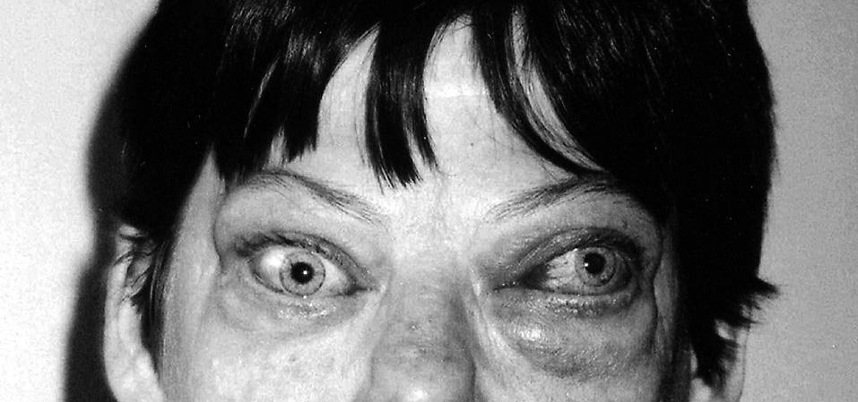 Patient MB in 1991, 2 years prior to diagnosis of Graves- Basedow disease and hyperthyroidism (printed with patient s permission) wrzodziejącego zapalenia jelit, skutecznie leczonego sulfasalazyną.