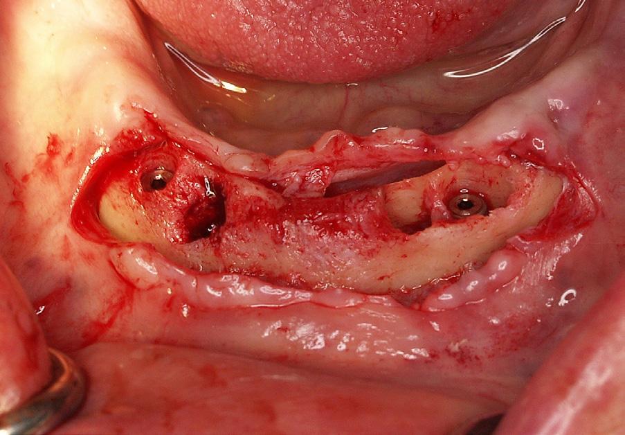W tej sytuacji zdecydowano o wszczepieniu implantów In-Kone (Global D, Francja) średnicy 3,5 i długości 10 mm w miejscu kła i pierwszego zęba przedtrzonowego (ryc. 12).