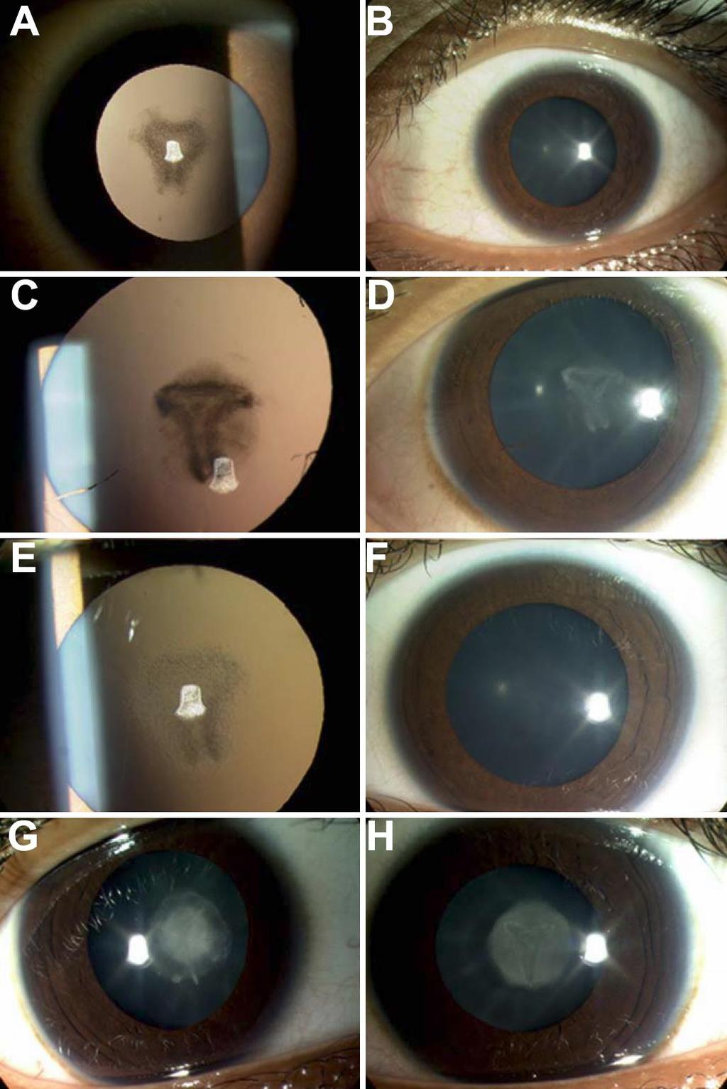 Katarakta A: Left eye retroillumination view and B: left eye slitlamp view of patient II:3. C: Left eye retroillumination view and D: left eye slit lamp view of patient II:5.