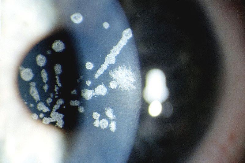 Dystrofia rogówki