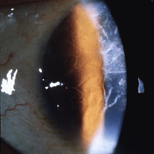 Dystrofia rogówki