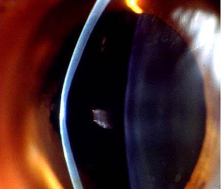 Optic section of a keratoconic eye showing significant apical
