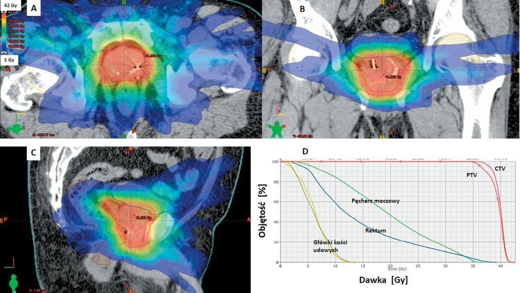 Rycina 2. Zaplanowany rozkład dawki dla CyberKnife w płaszczyźnie: A poprzecznej, B czołowej, C strzałkowej oraz D DVH. Dawka całkowita 36,25 Gy została zdefiniowana na izodozie 85%.