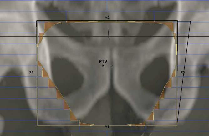 Width of Multileaf Collimator influence for size of irradiated structure PRV 39 A mean target volume was 255.65cm 3 (range 98.36 388.82cm 3 ), and the mean PRV volume was 997.17 cm 3 (range 545.