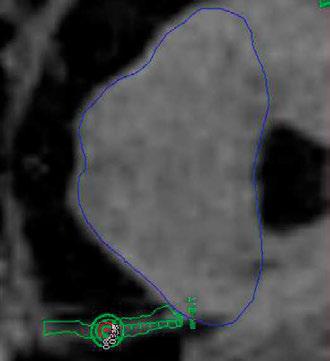 radioterapia \ radiotherapy artykuł naukowy \ scientific paper Metoda Gamma Knife w leczeniu bólów neuralgicznych Pierwsze udokumentowane leczenie bólu neuralgicznego nerwu trójdzielnego o