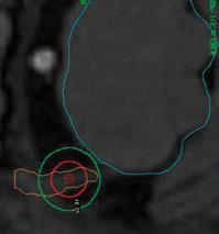W Ośrodku Exira Gamma Knife w Katowicach w leczeniu zmian zlokalizowanych w obszarze głowy wykorzystywane jest urządzenie Gamma Knife Perfexion, które w swojej budowie posiada 192 źródła izotopu Co