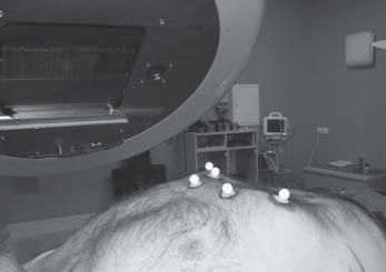 Initial assessment of tolerance and efficacy of local extracranial radiosurgery in patients with primary and metastasizing liver tumors 39 go (w punktach o względnie małej ruchomości oddechowej)