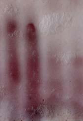 Anemia, testy ciążowe Zaburzenia rozwoju mięśni OcAP Osteoklasty 19 Choroby kości Jęczmień Przesunięcie grupy prążków Lolium Izoenzymy kwaśnej fosfatazy u roślin często są efektem obróbki