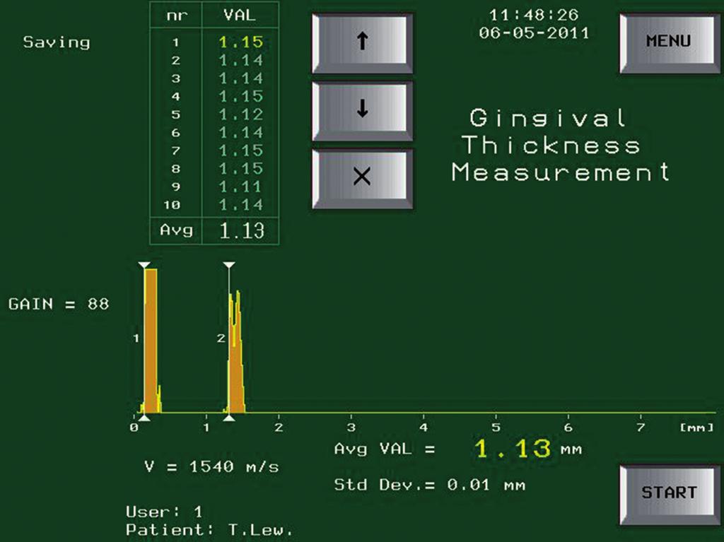 In order to examine gingival thickness, chlorhexidine gel was applied on the head of the probe that was applied to an external surface of the mucosa, without pressuring soft tissues, perpendicularly